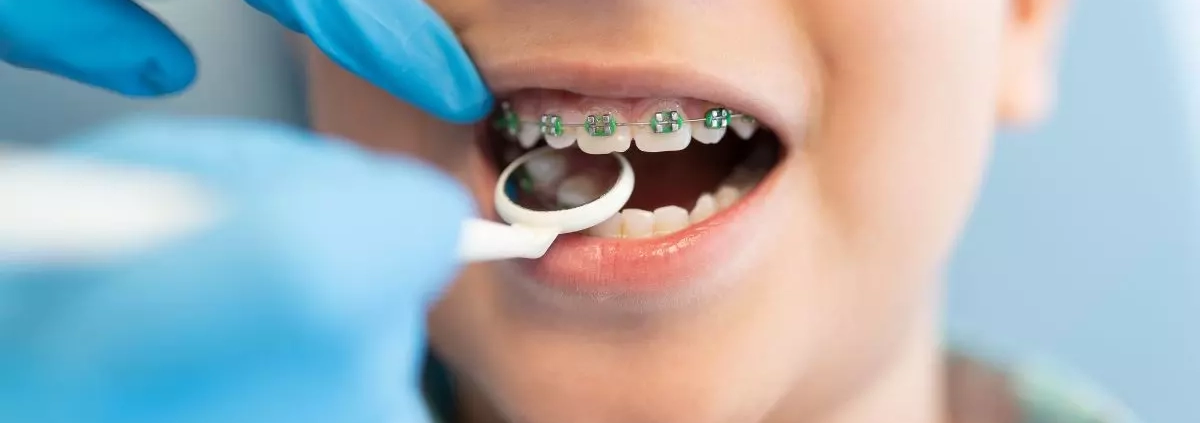 Apparecchio ortodontico per bambini